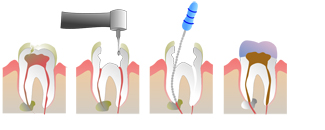 root canal treatment